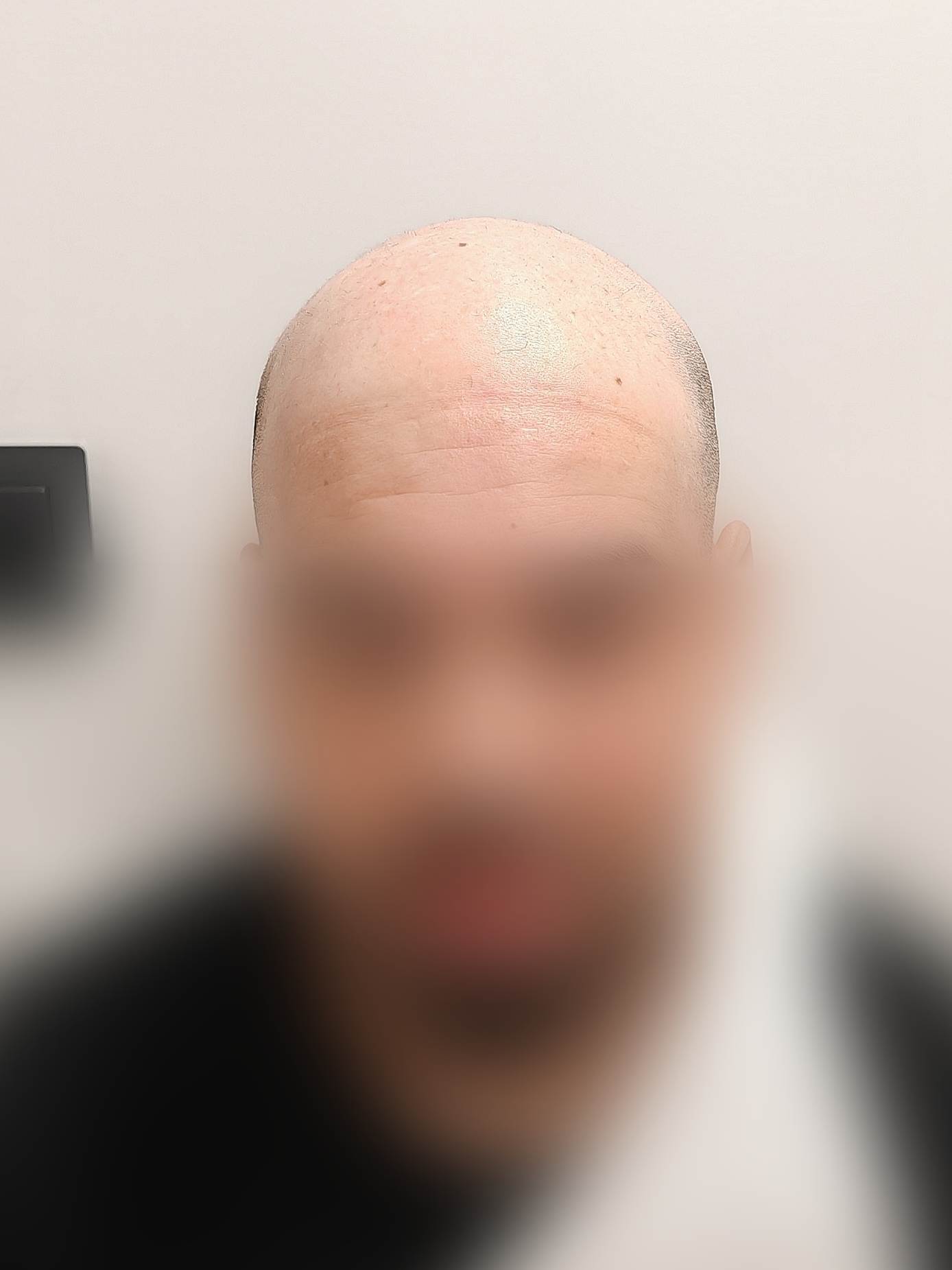 Antes frontal (1) Antes frontal (1)