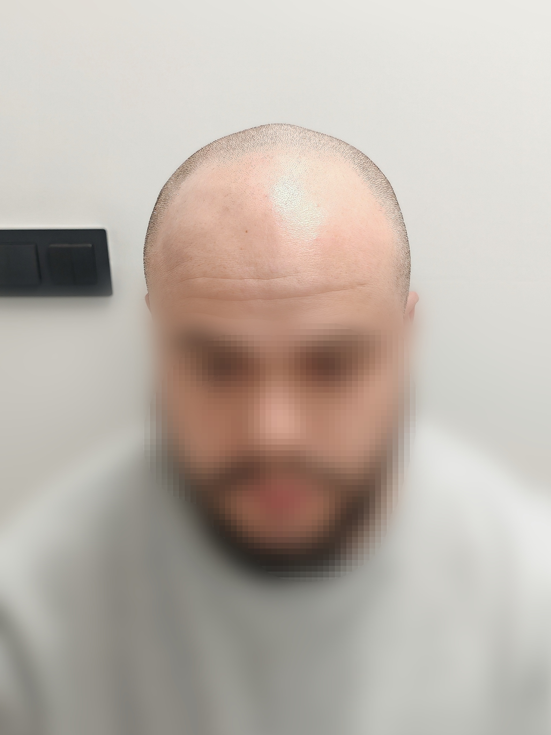 Antes frontal 1 Antes frontal 1