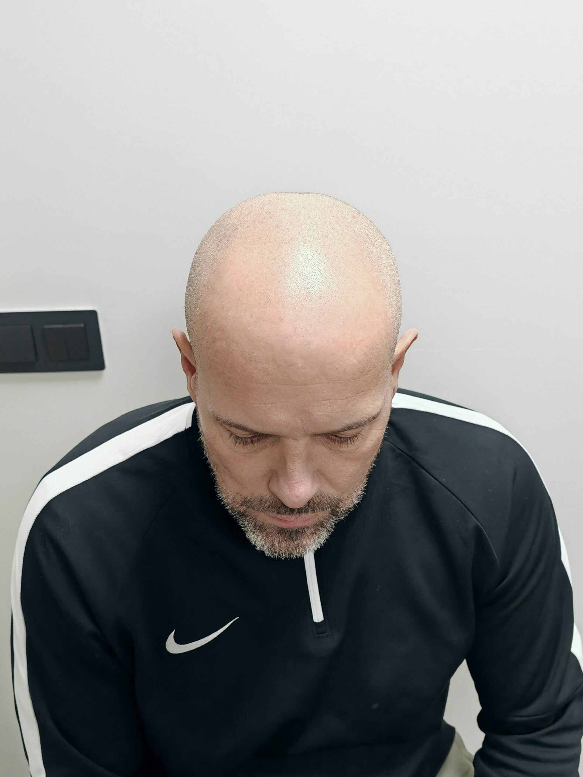 Antes_frontal (1) Antes_frontal (1)