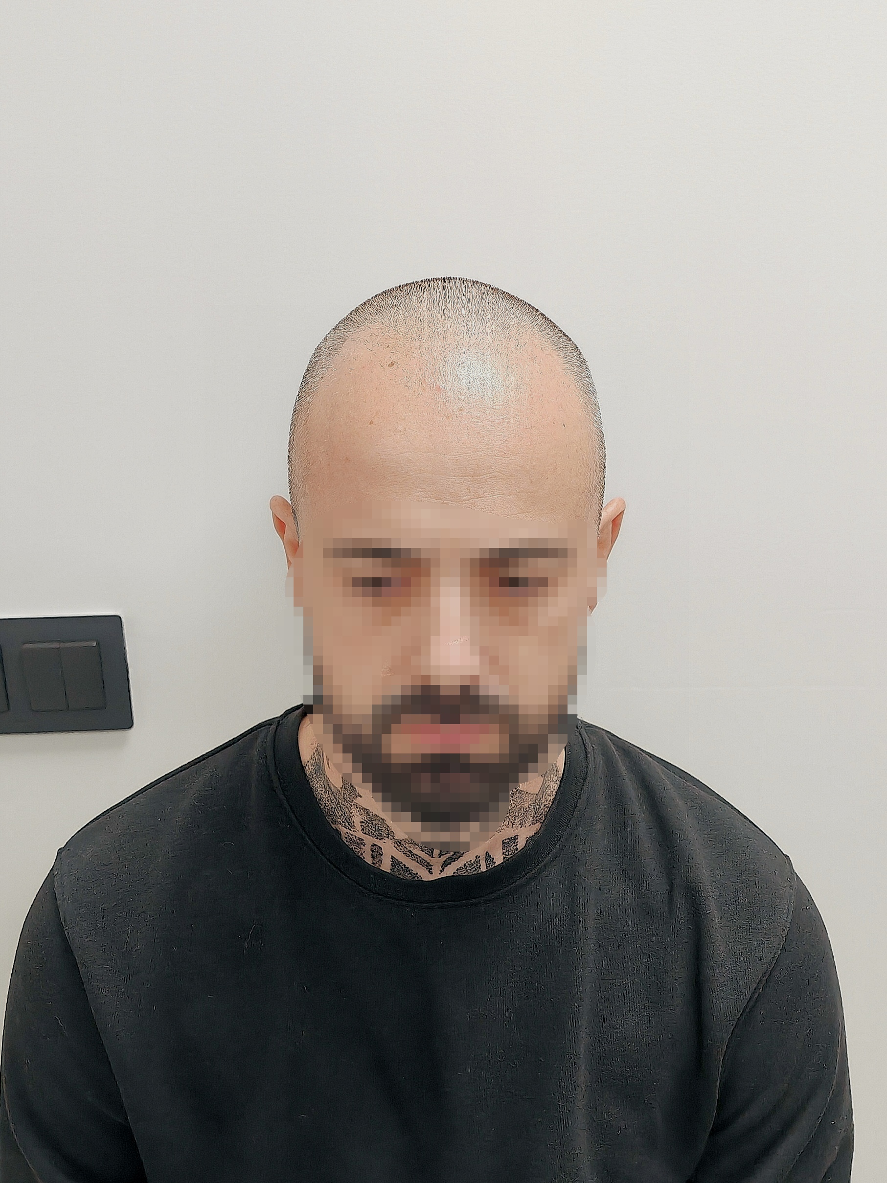 Antes_frontal1 (2) Antes_frontal1 (2)